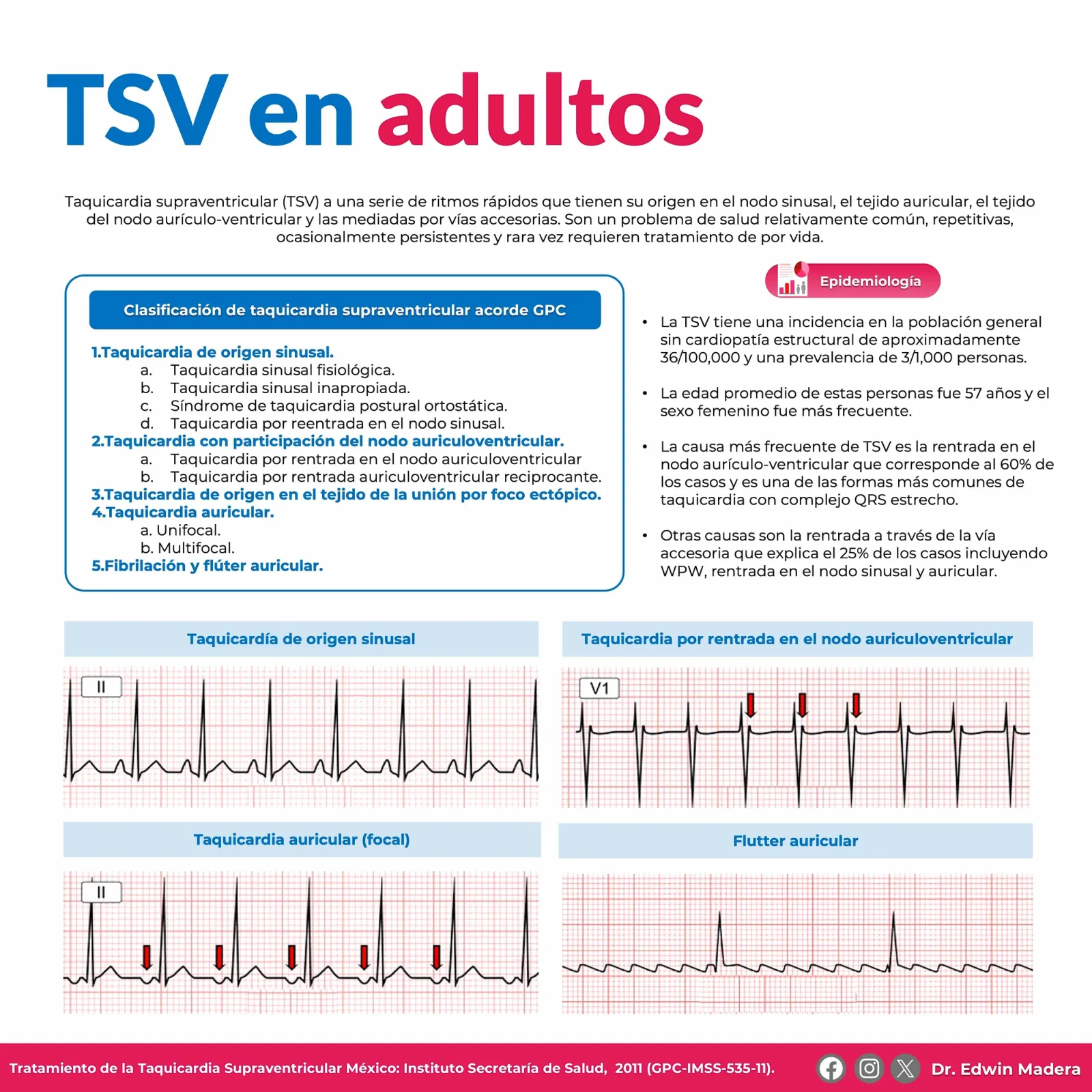 Taquicardia supraventricular