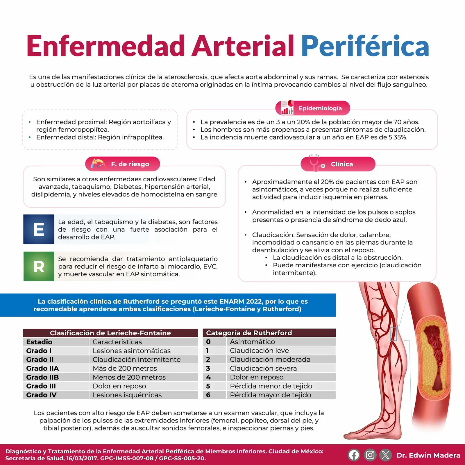 Enfermedad arterial periférica