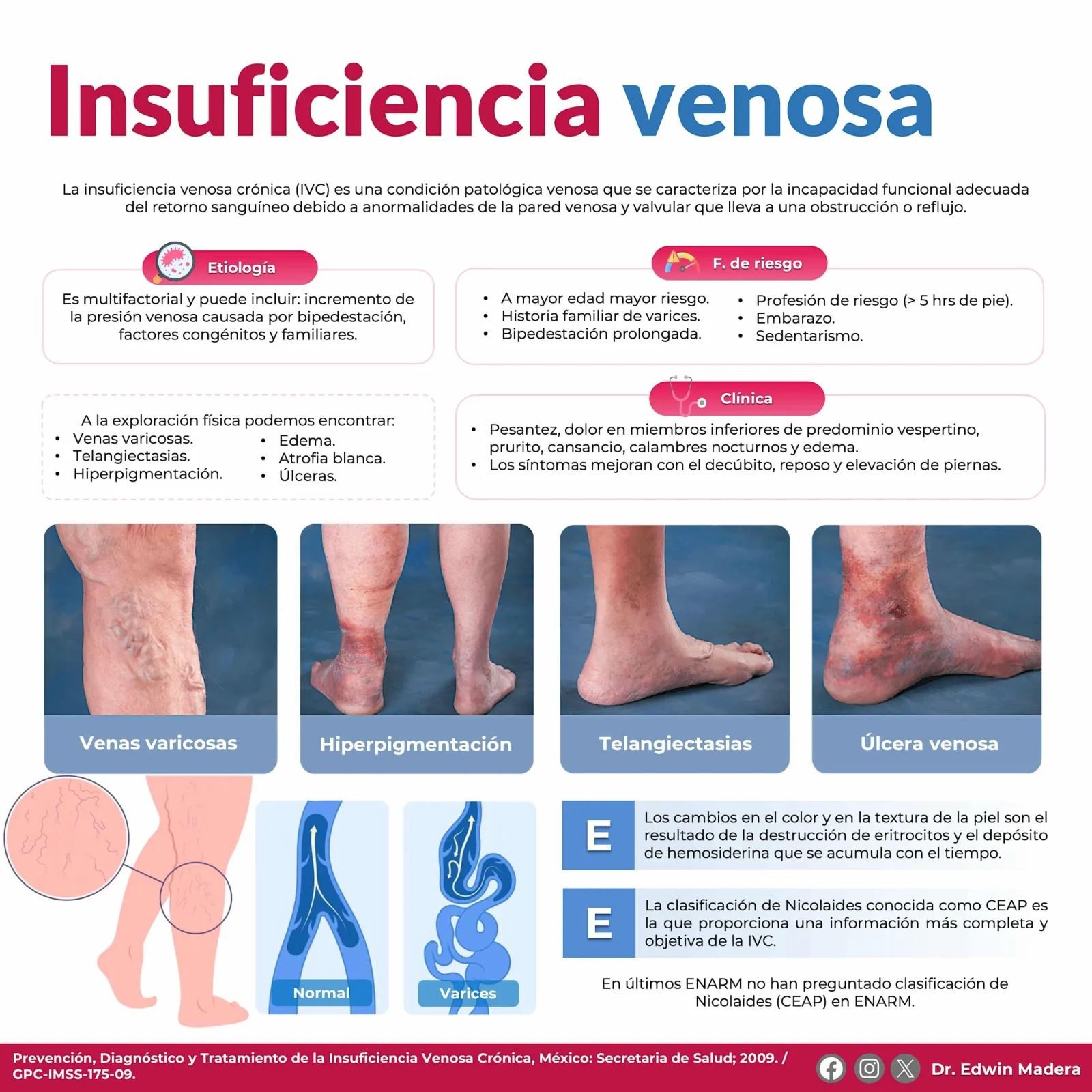 Insuficiencia venosa