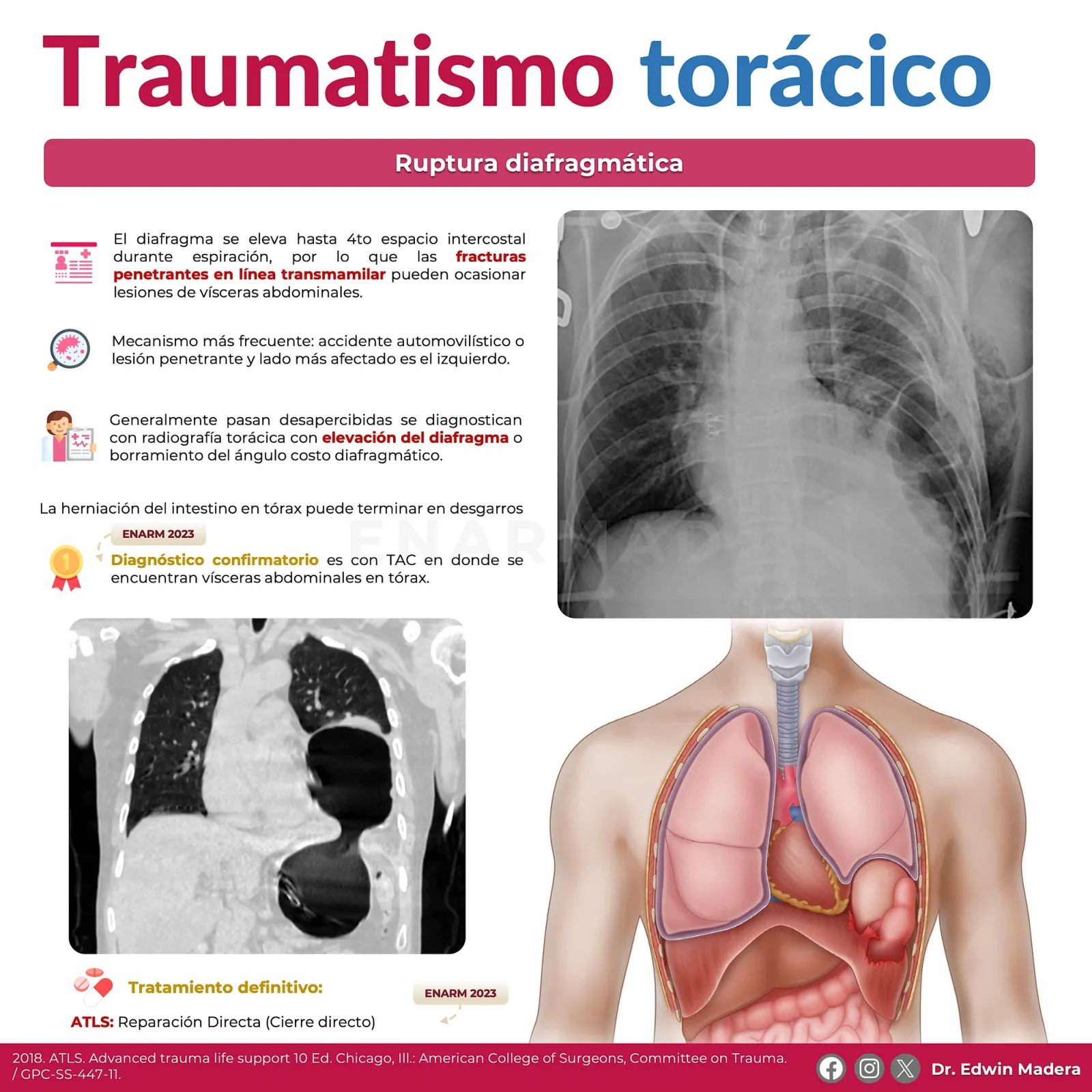 Ruptura diafragmática