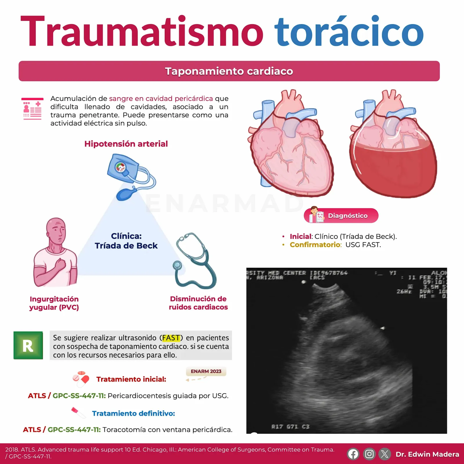Taponamiento cardiaco