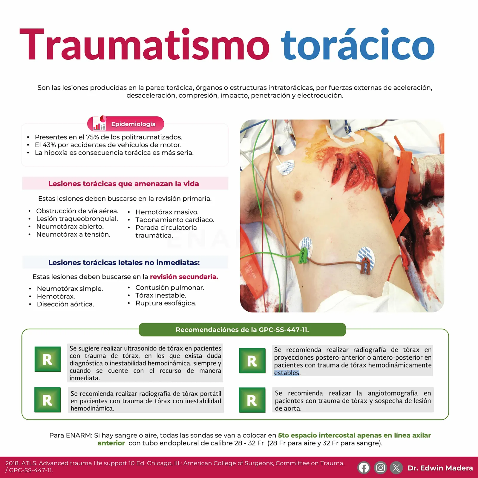 Trauma torácico