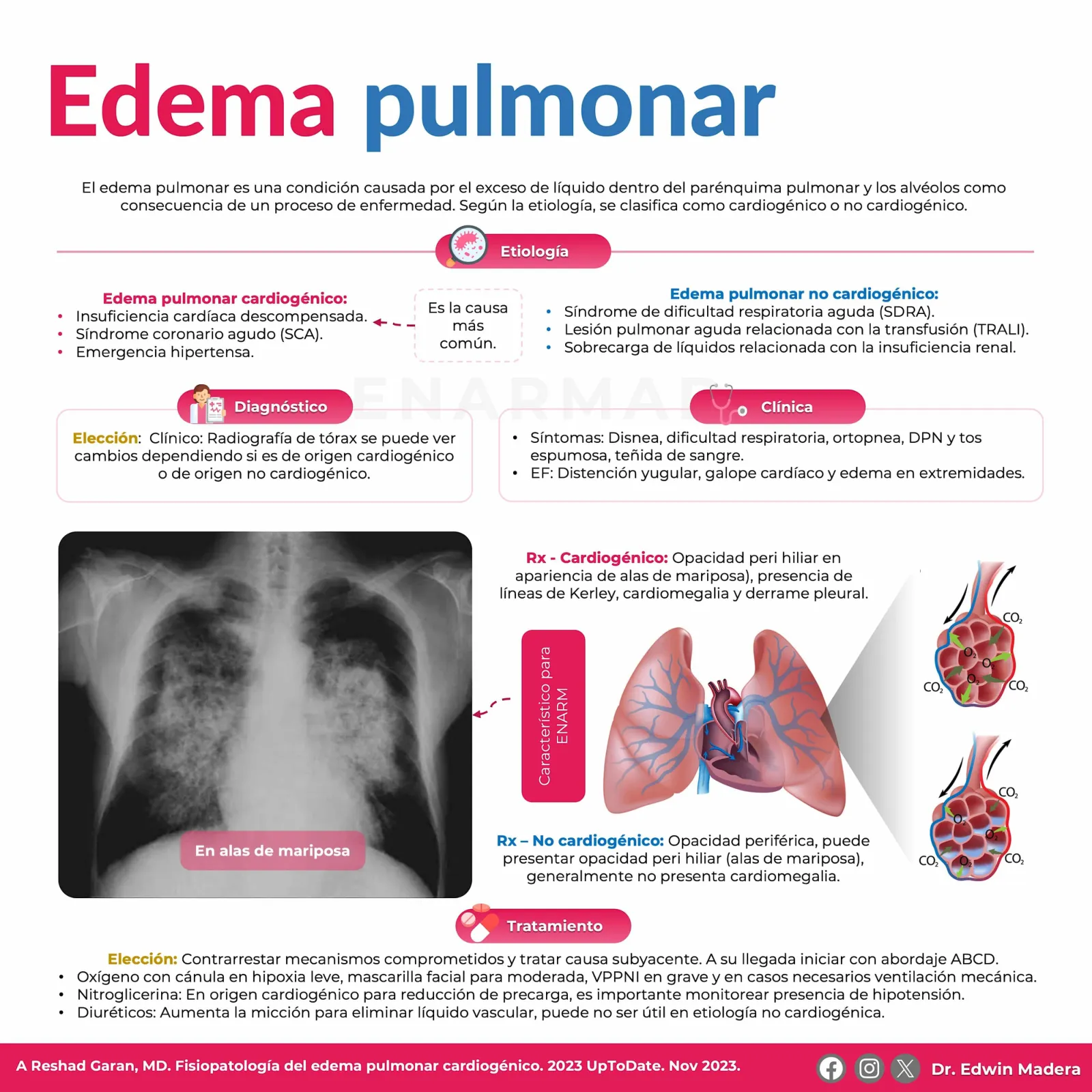 Edema pulmonar