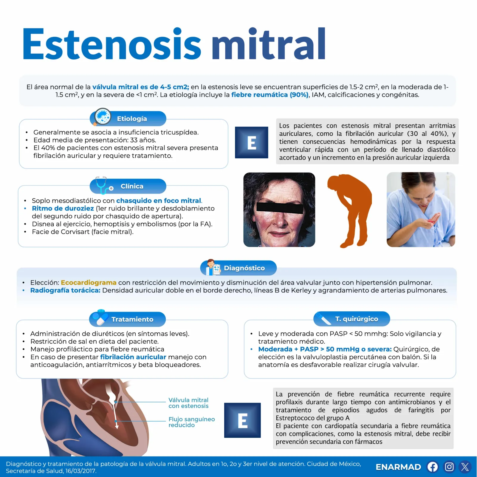 Estenosis mitral
