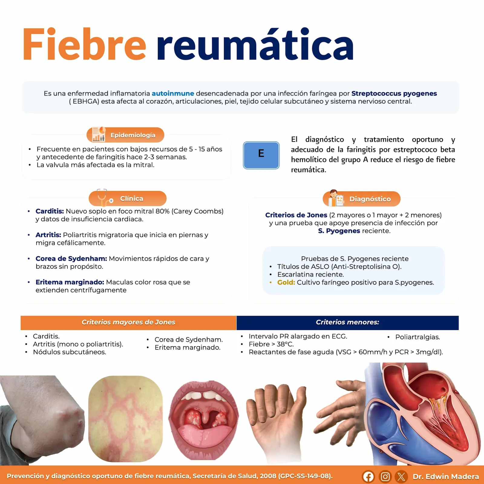 Fiebre reumática