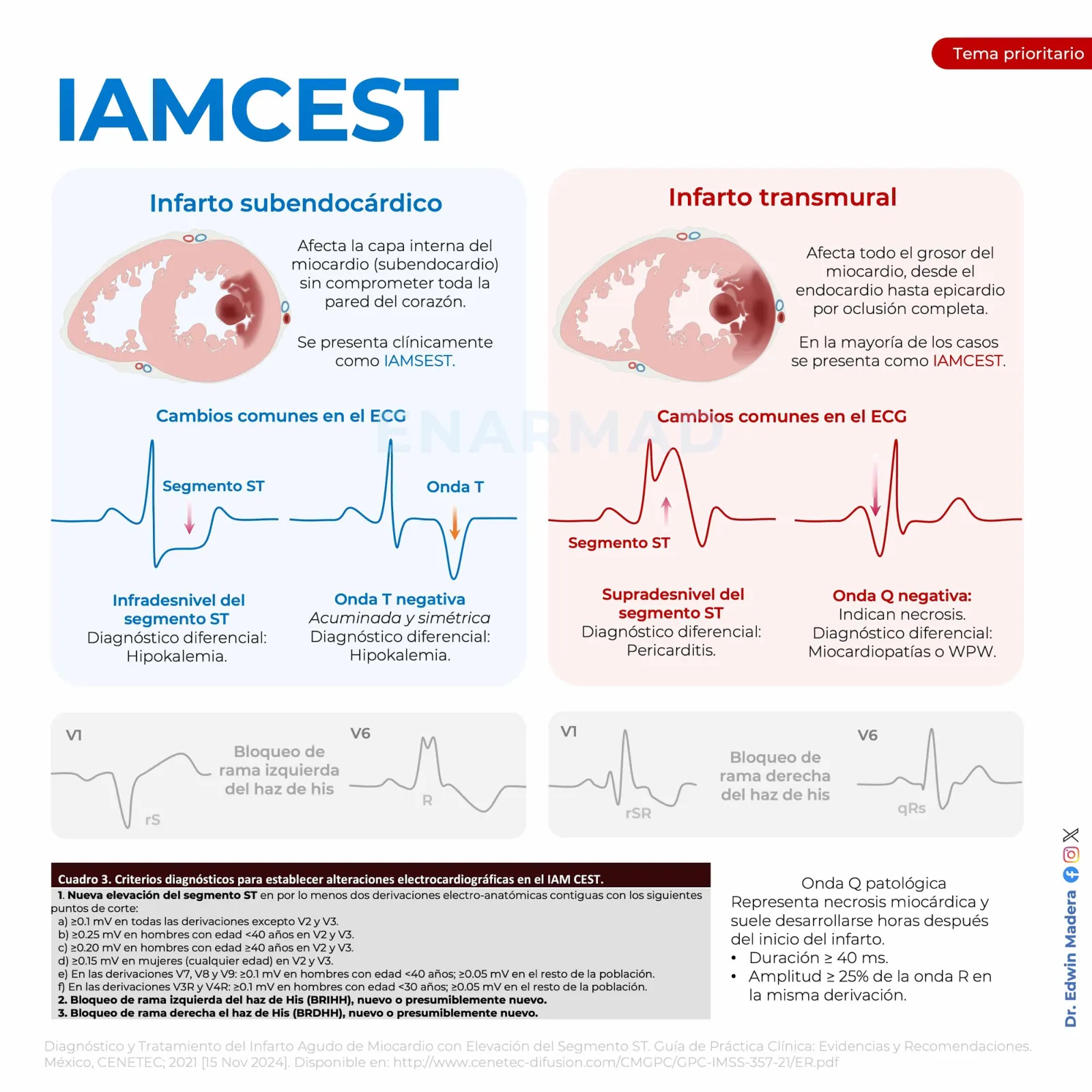 Infarto agudo de miocardio