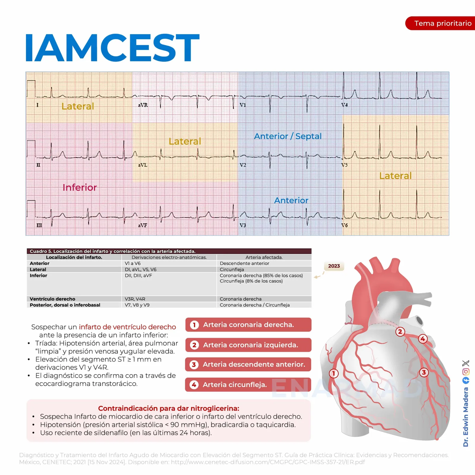 Infarto agudo de miocardio