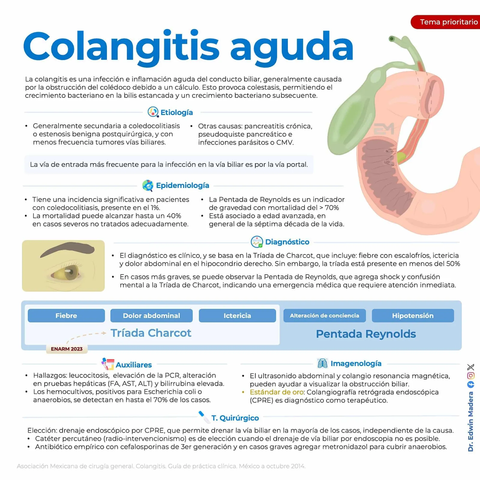 Colelitiasis