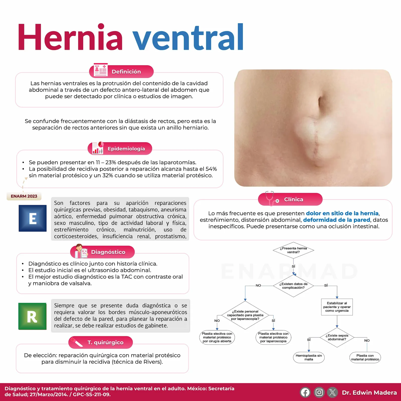 Hernia ventral