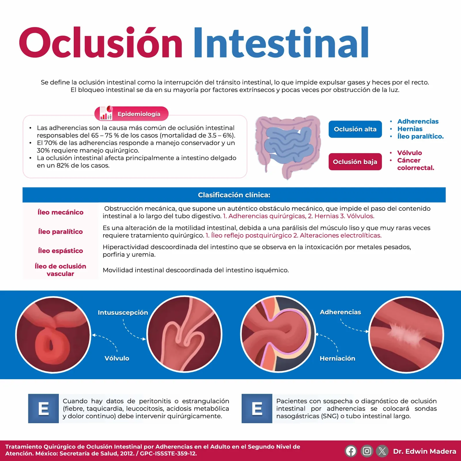 Oclusión intestinal