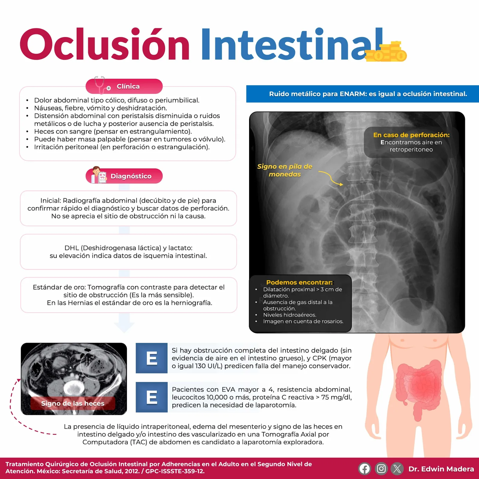 Oclusión intestinal