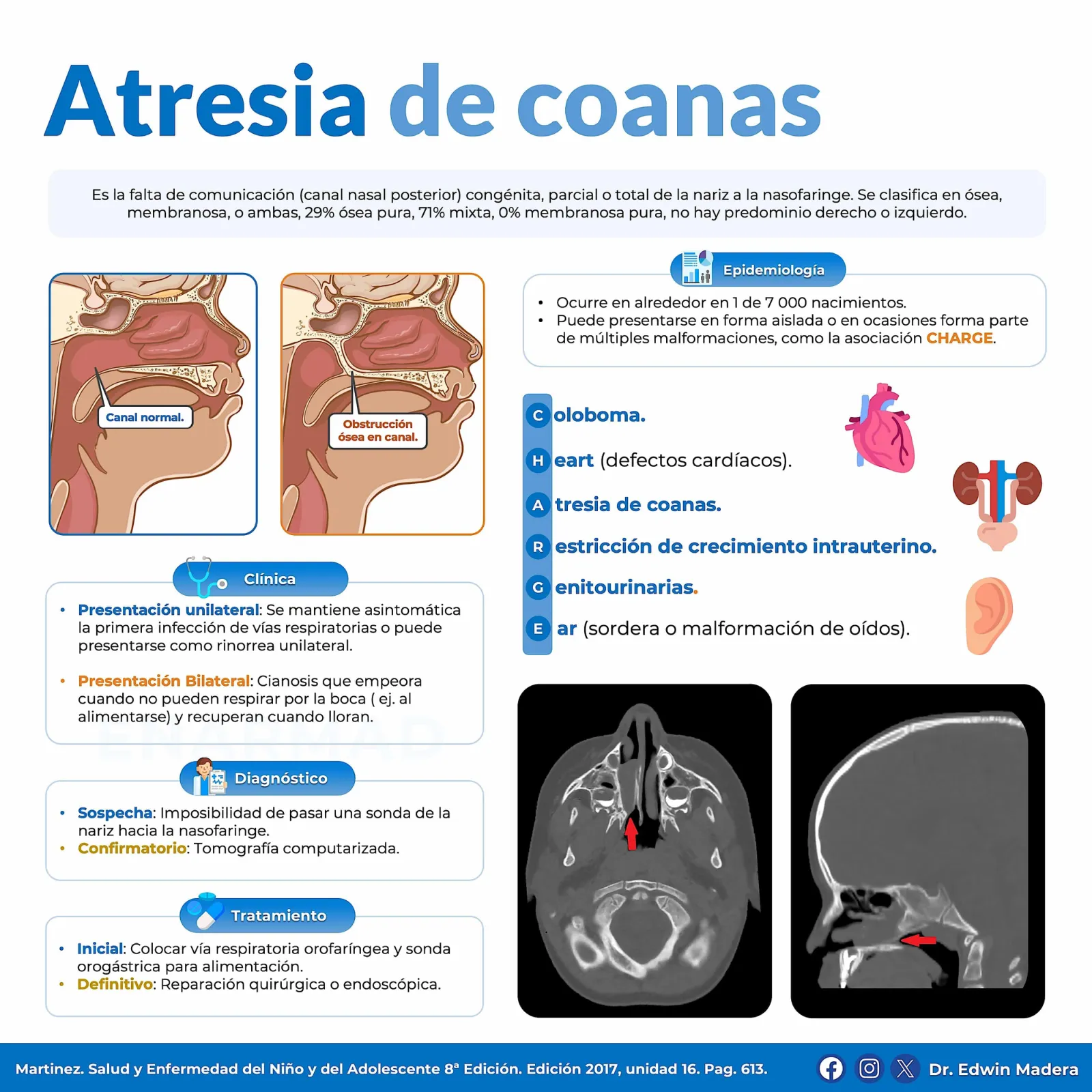 Atresia de coanas