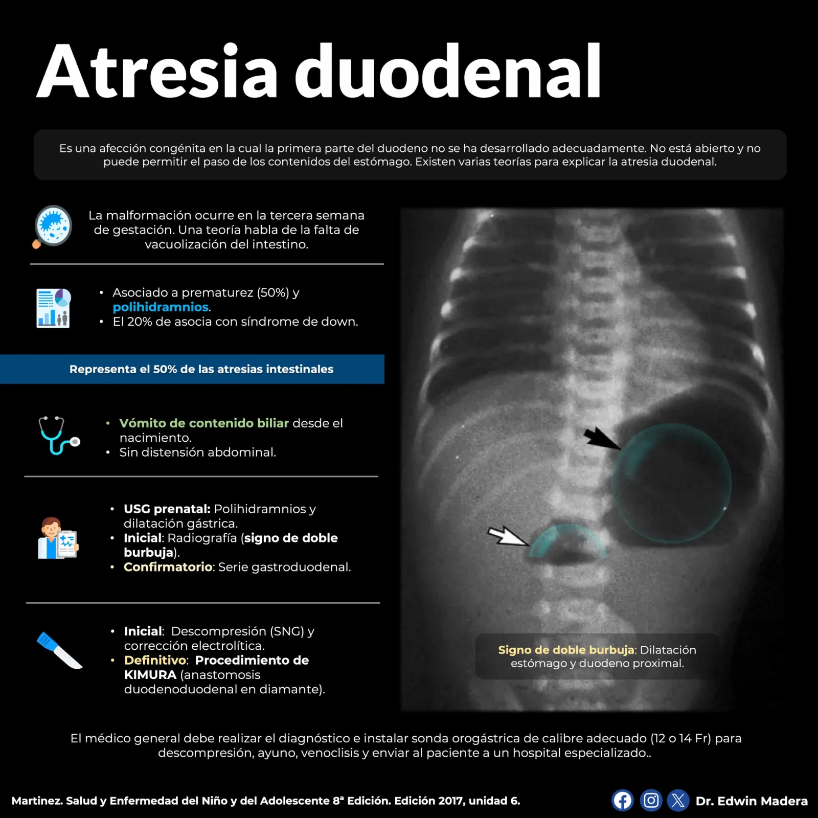 Atresia duodenal