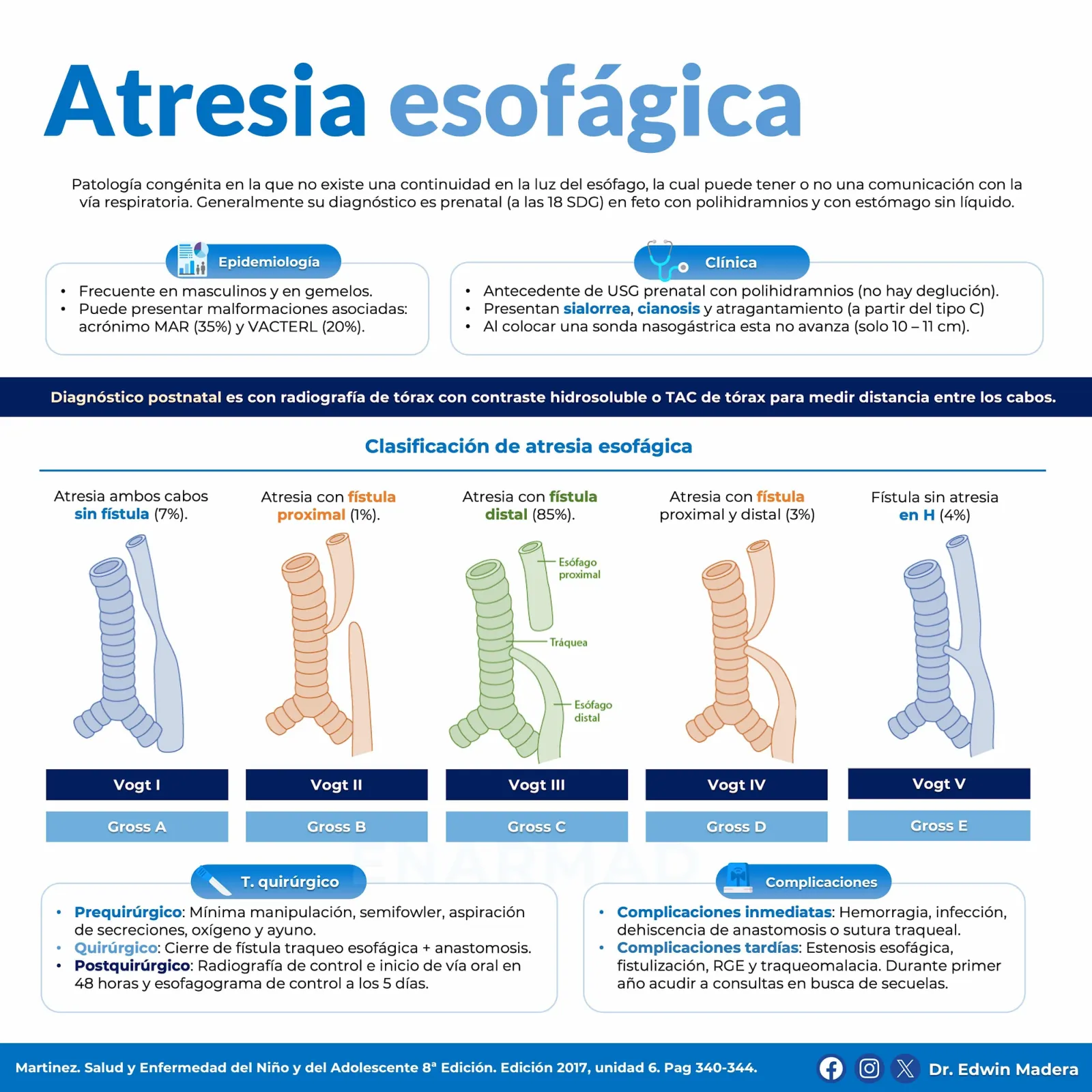 Atresia esofágica