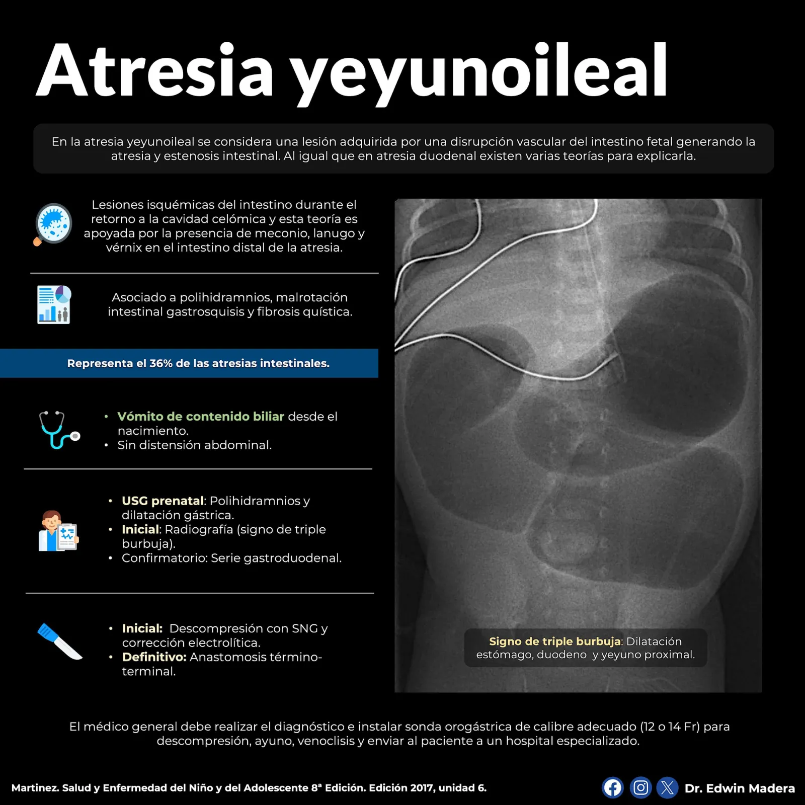 Atresia yeyunoileal