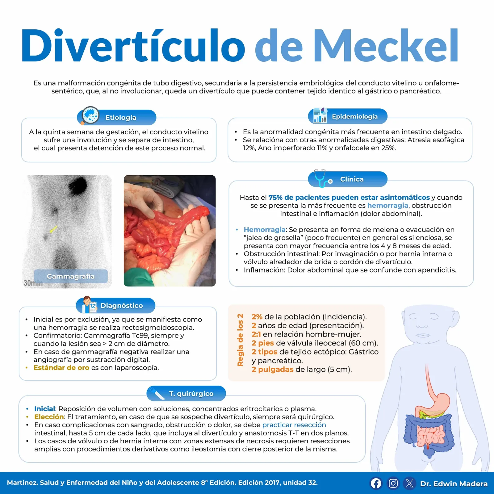 Divertículo de Meckel