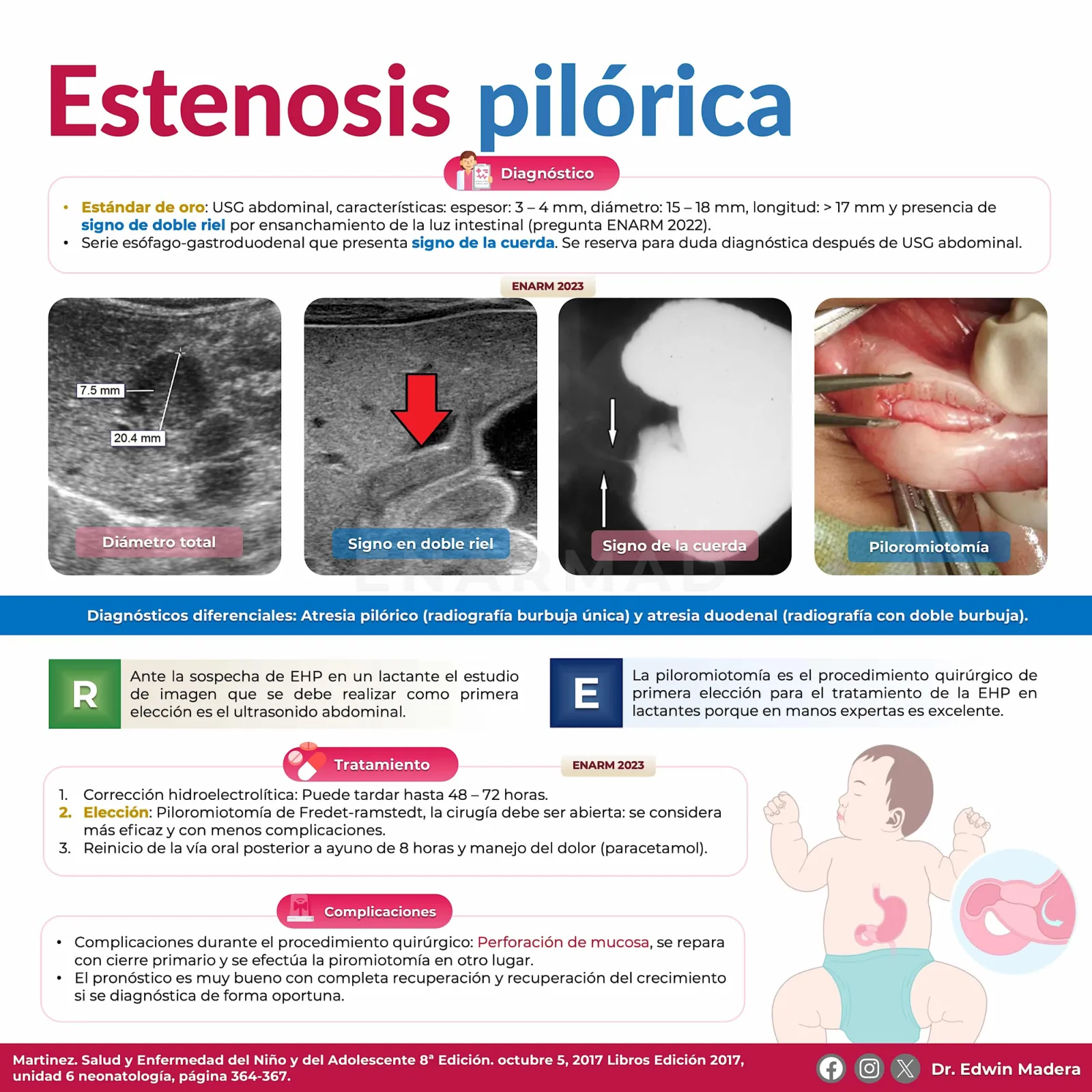 Estenosis pilórica