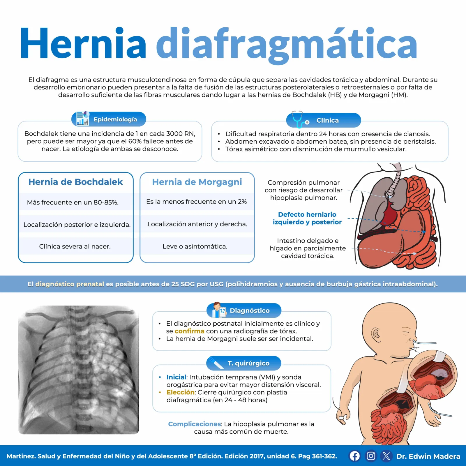 Hernía diafragmática congénita