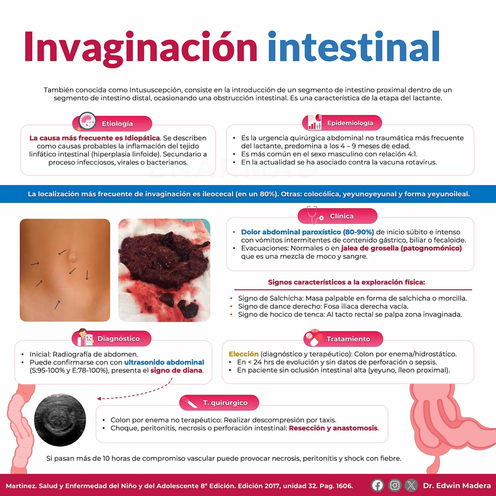 Invaginación intestinal