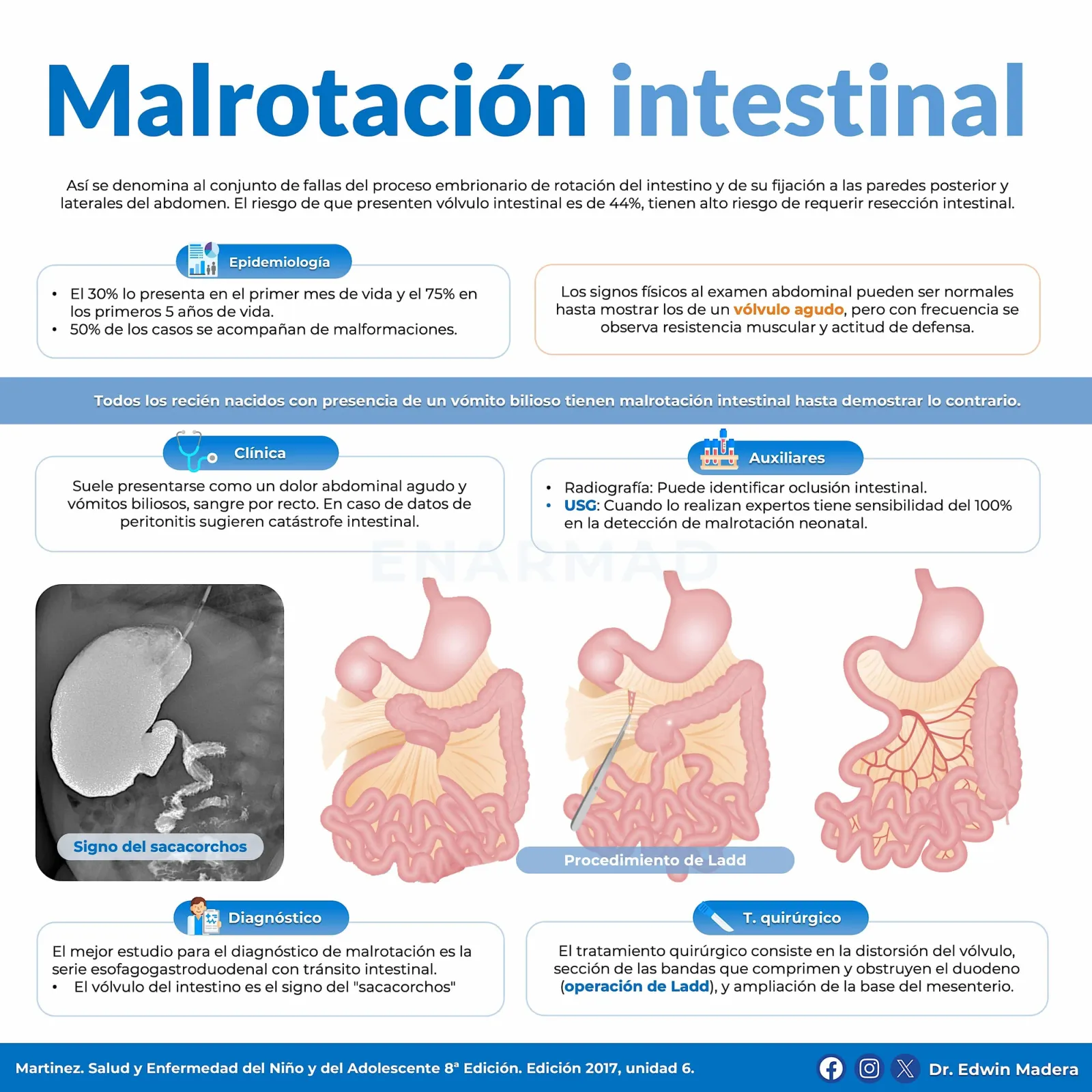 Malrotación intestinal