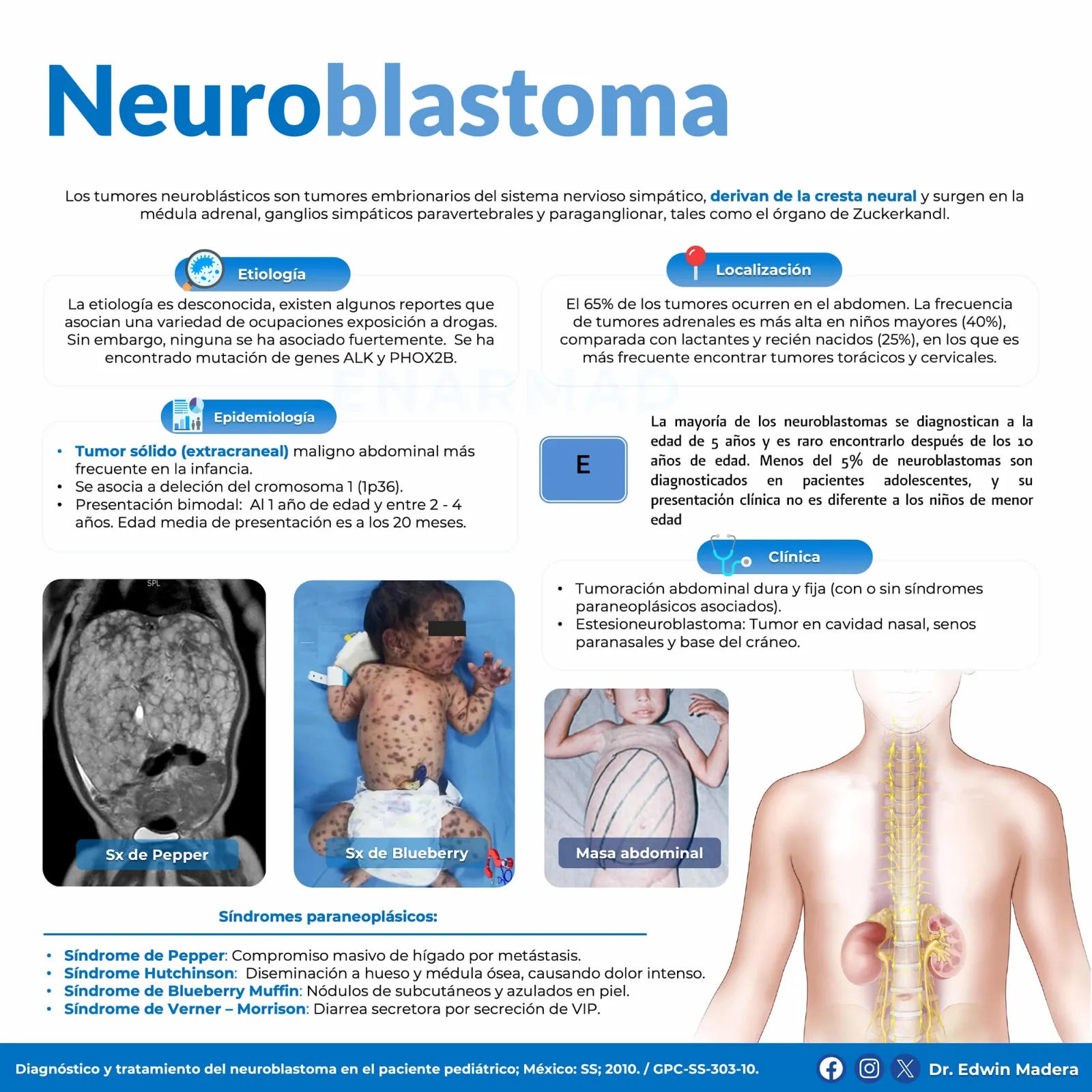Neuroblastoma