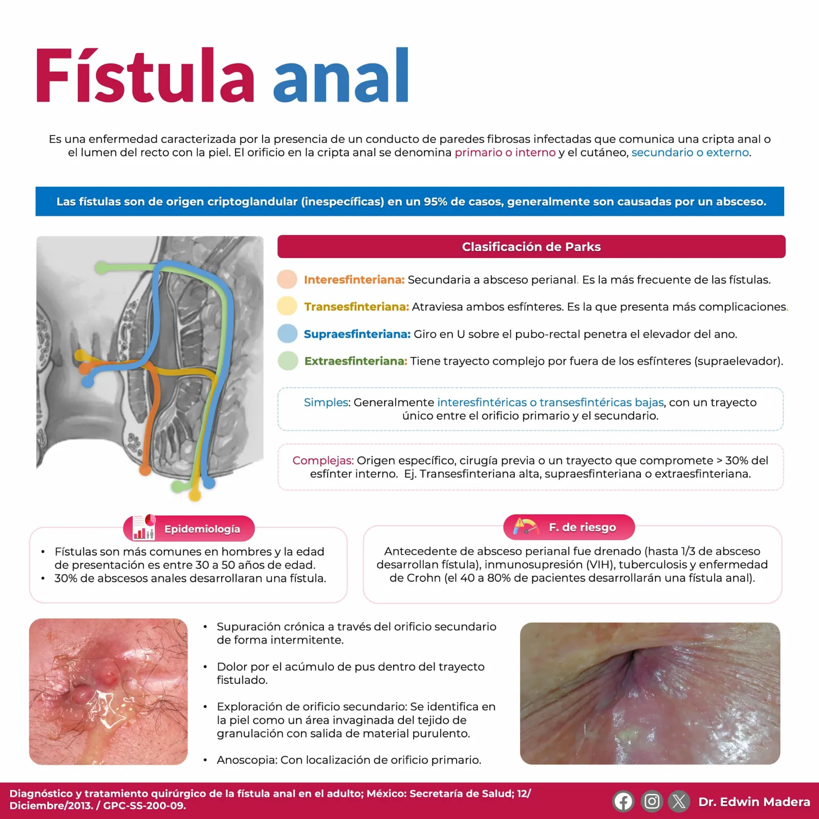 Fístula anal