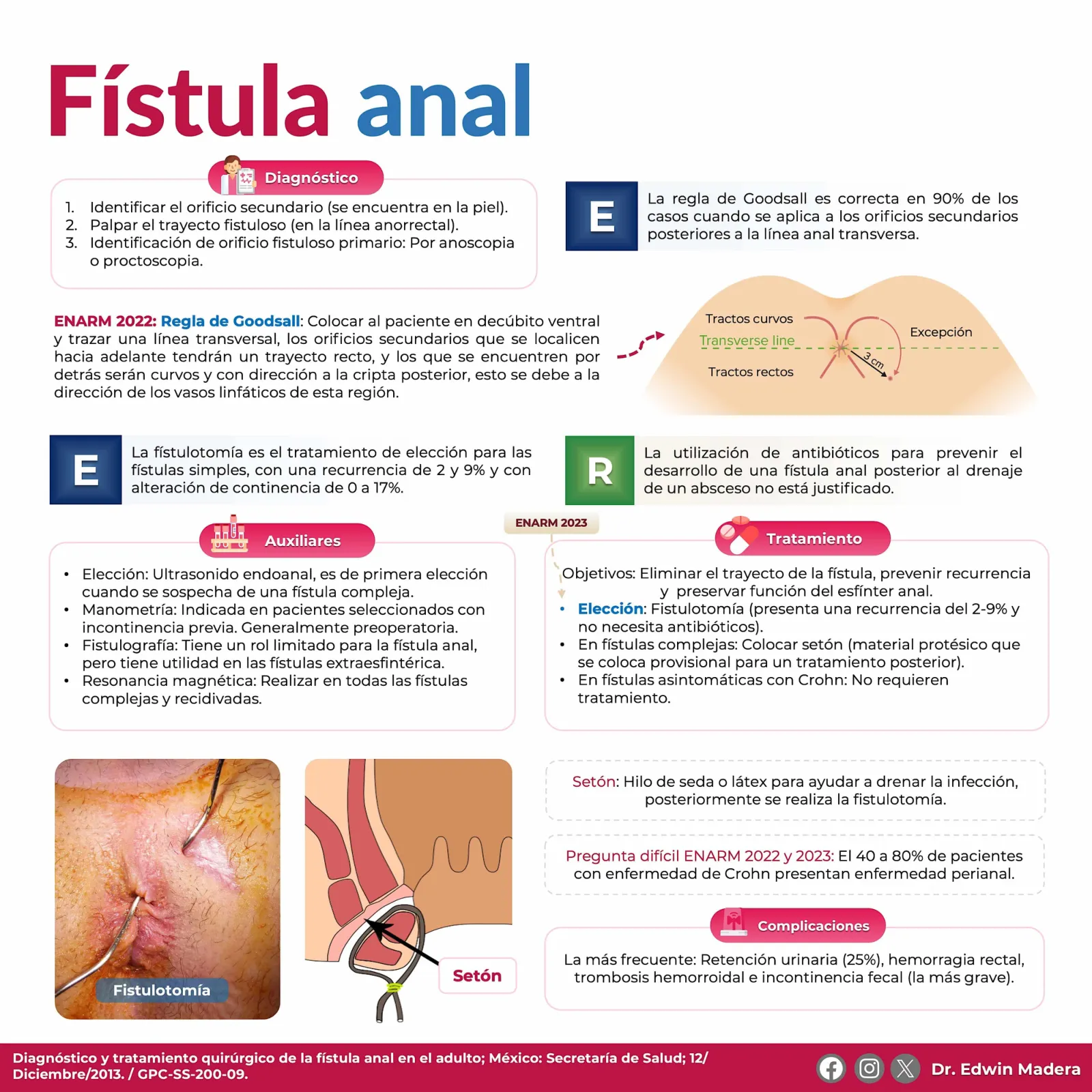 Fístula anal