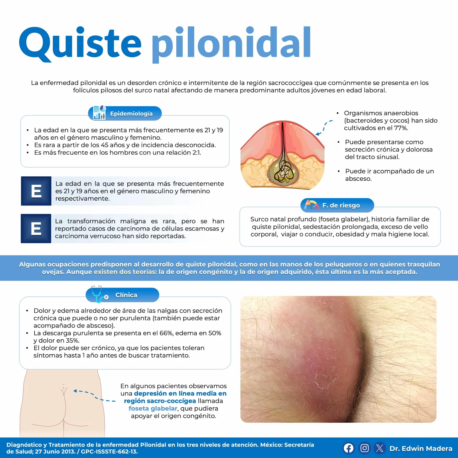 Quiste pilonidal