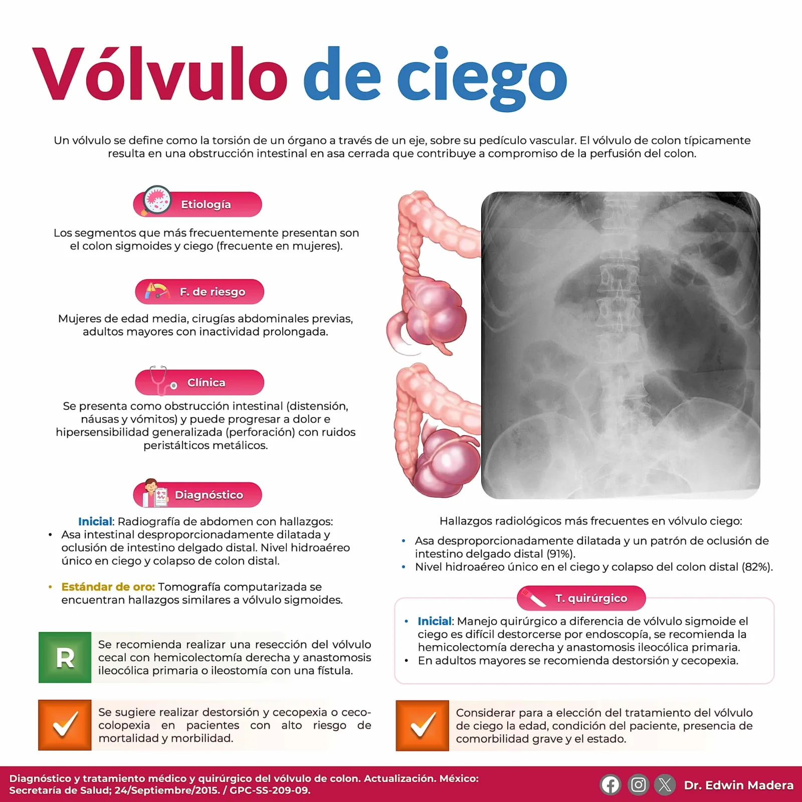 Vólvulo de ciego