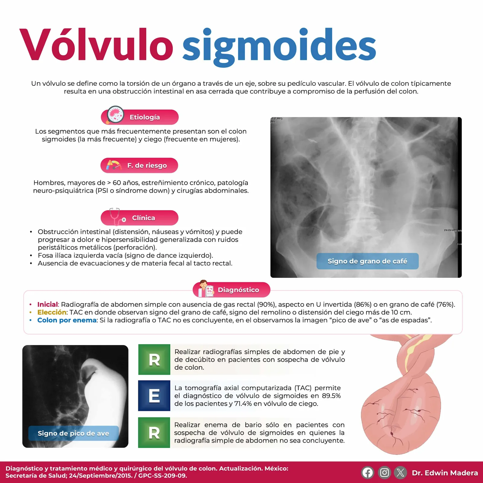 Vólvulo de sigmoides