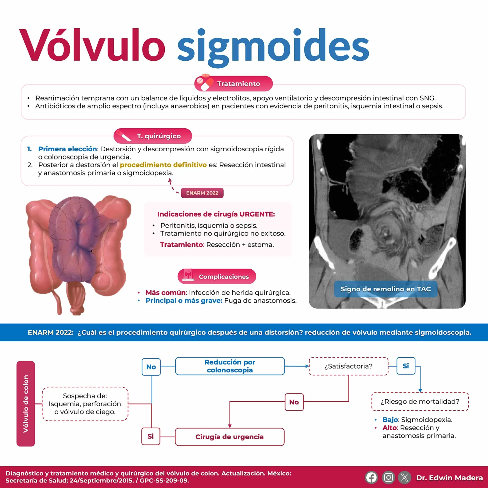 Vólvulo de sigmoides