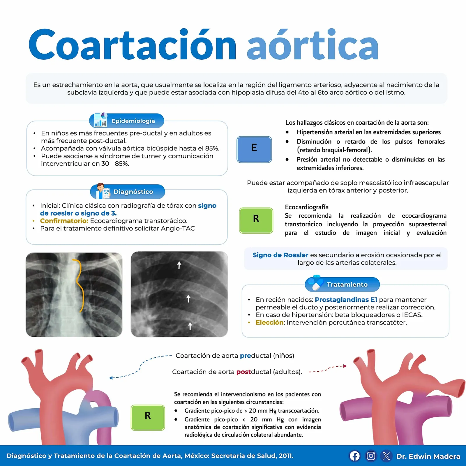 Coartación aórtica