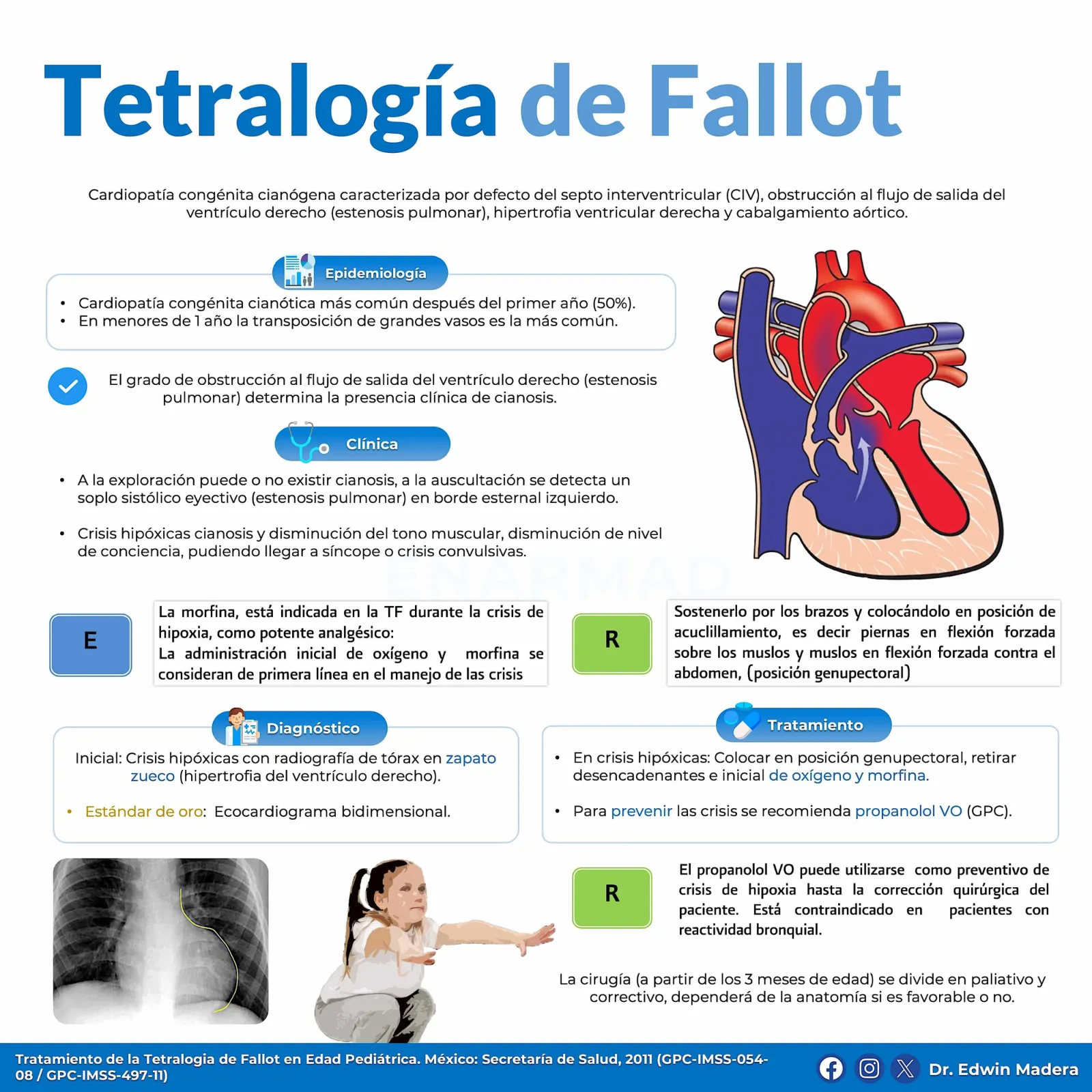 Tetralogía de Fallot