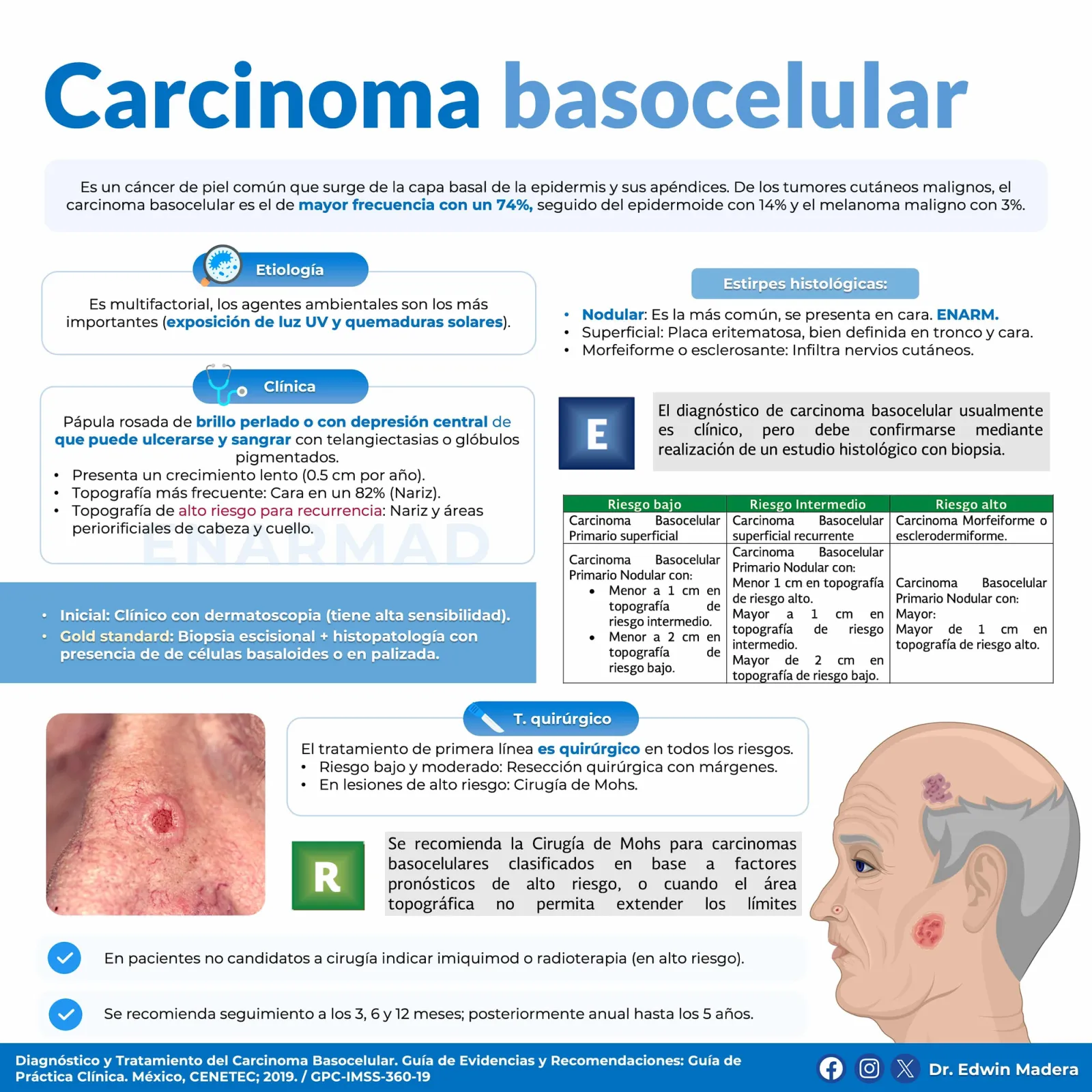 Carcinoma basocelular