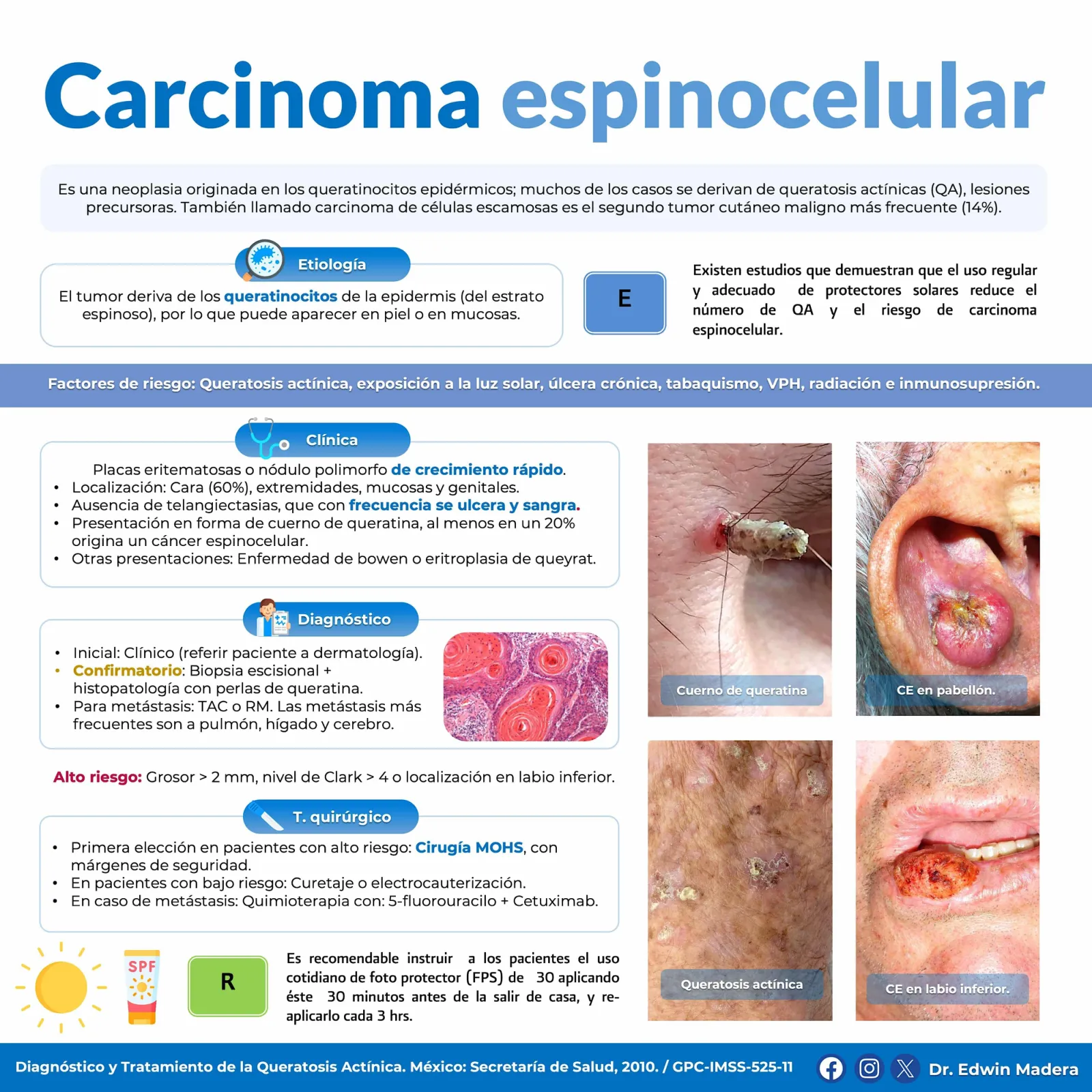 Carcinoma espinocelular