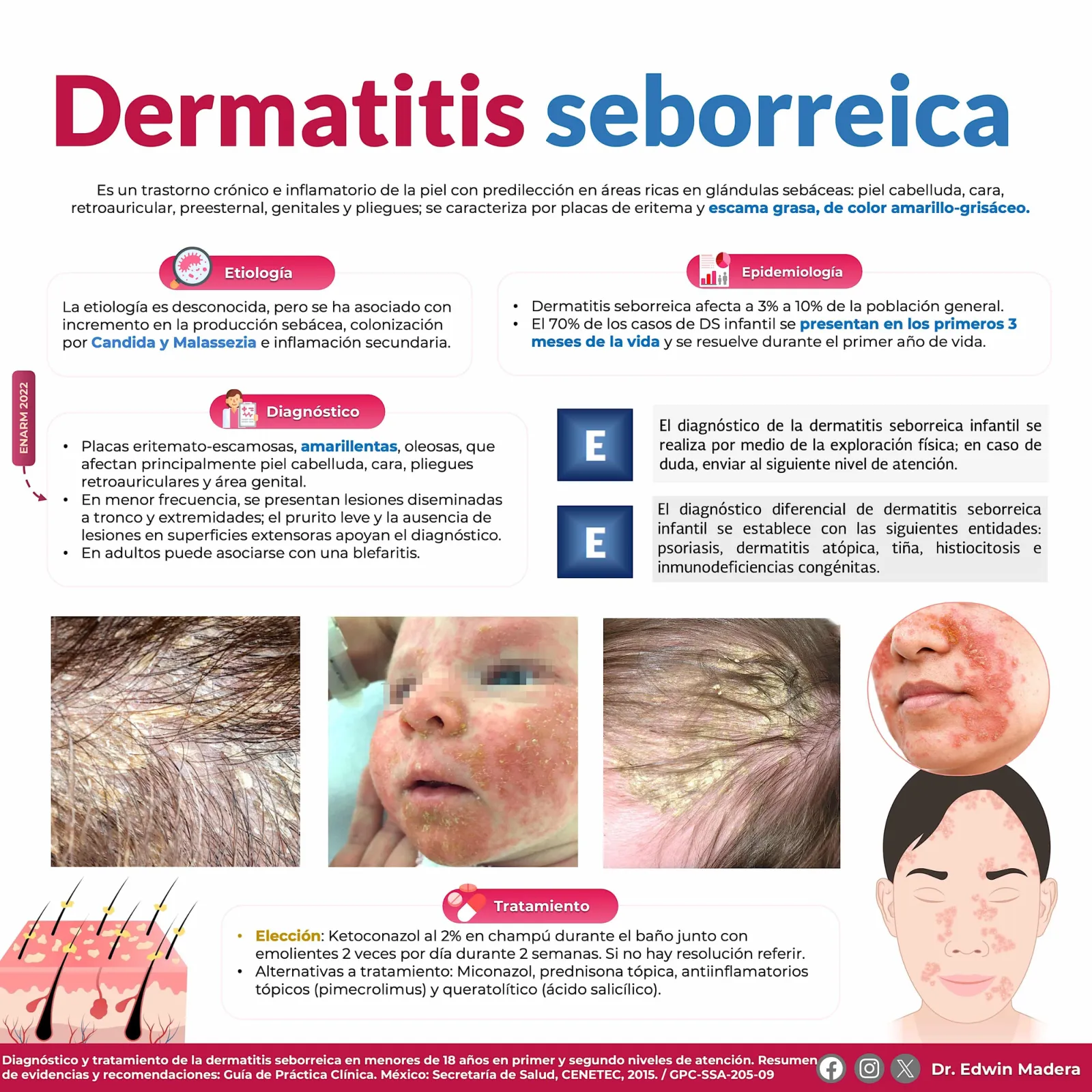 Dermatitis seborreica
