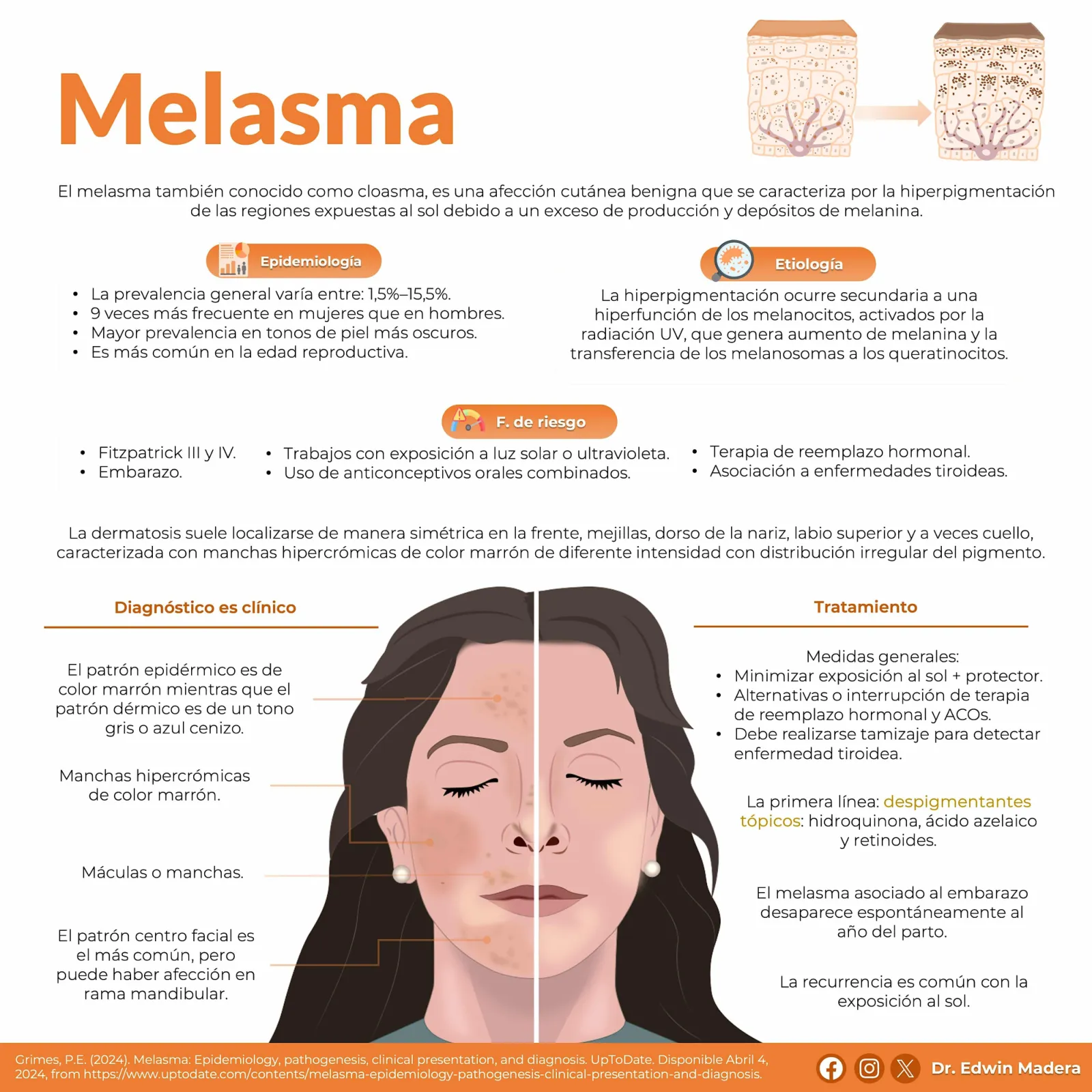 Melasma