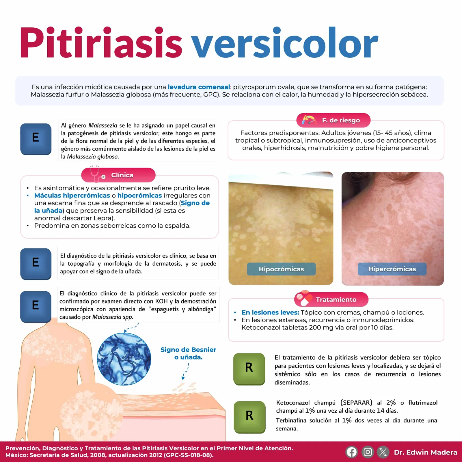 Pitiriasis versicolor