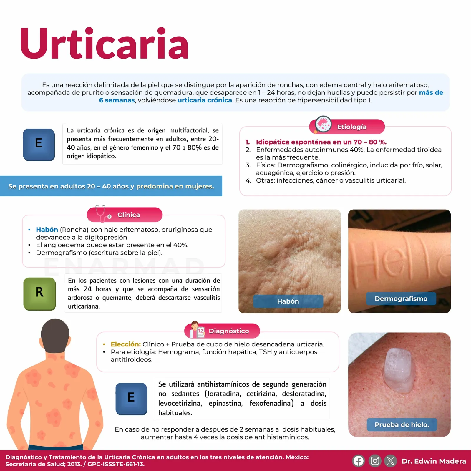 Urticaria