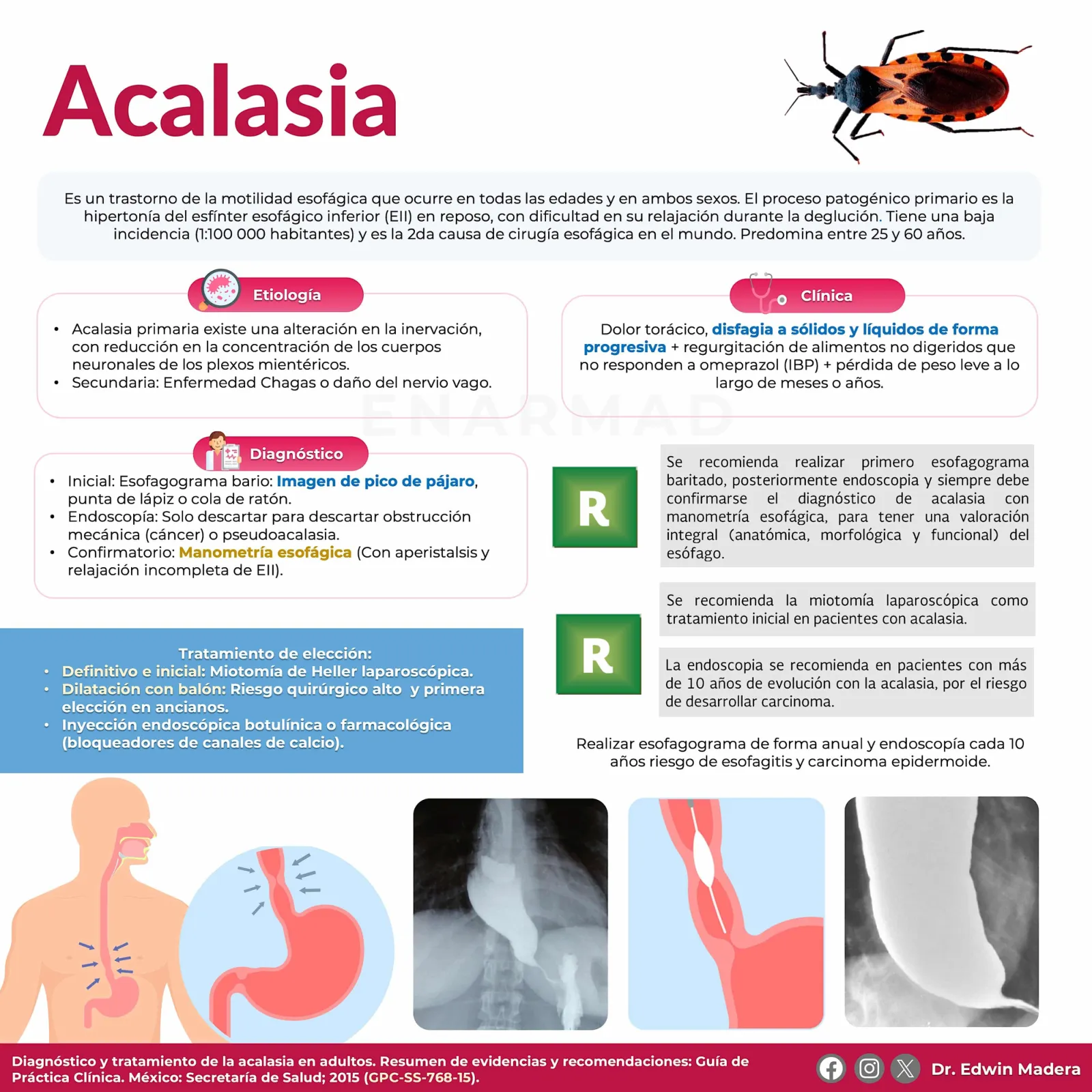 Acalasia