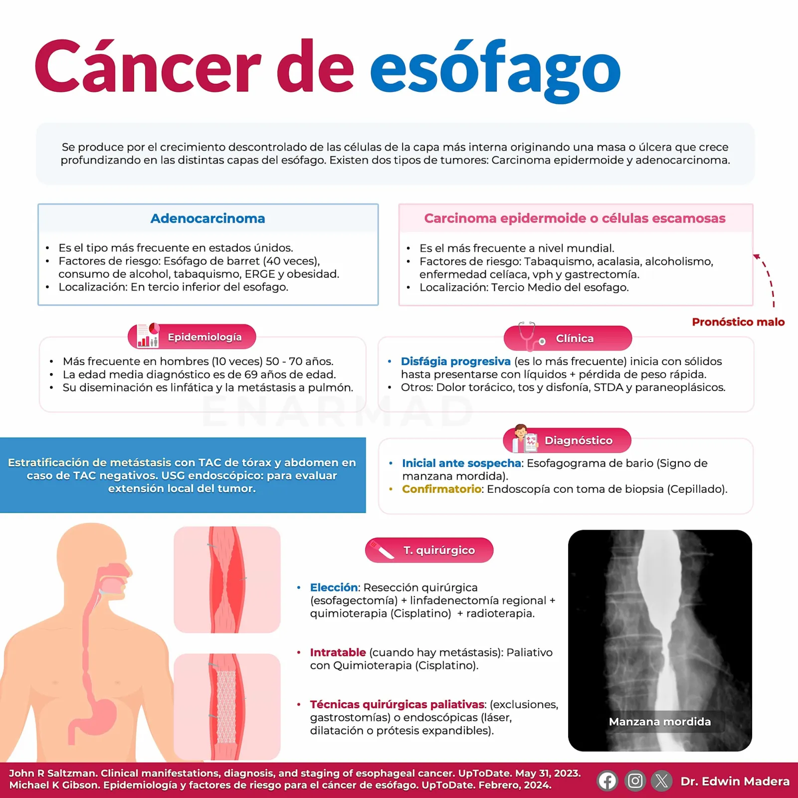 Cáncer de esófago