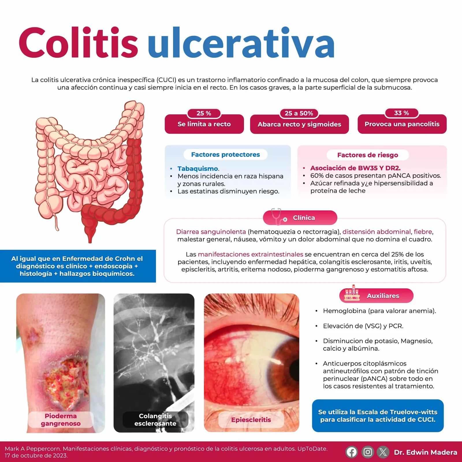 Colitis ulcerativa
