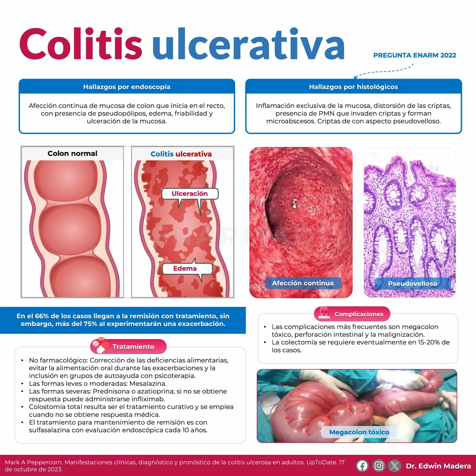 Colitis ulcerativa