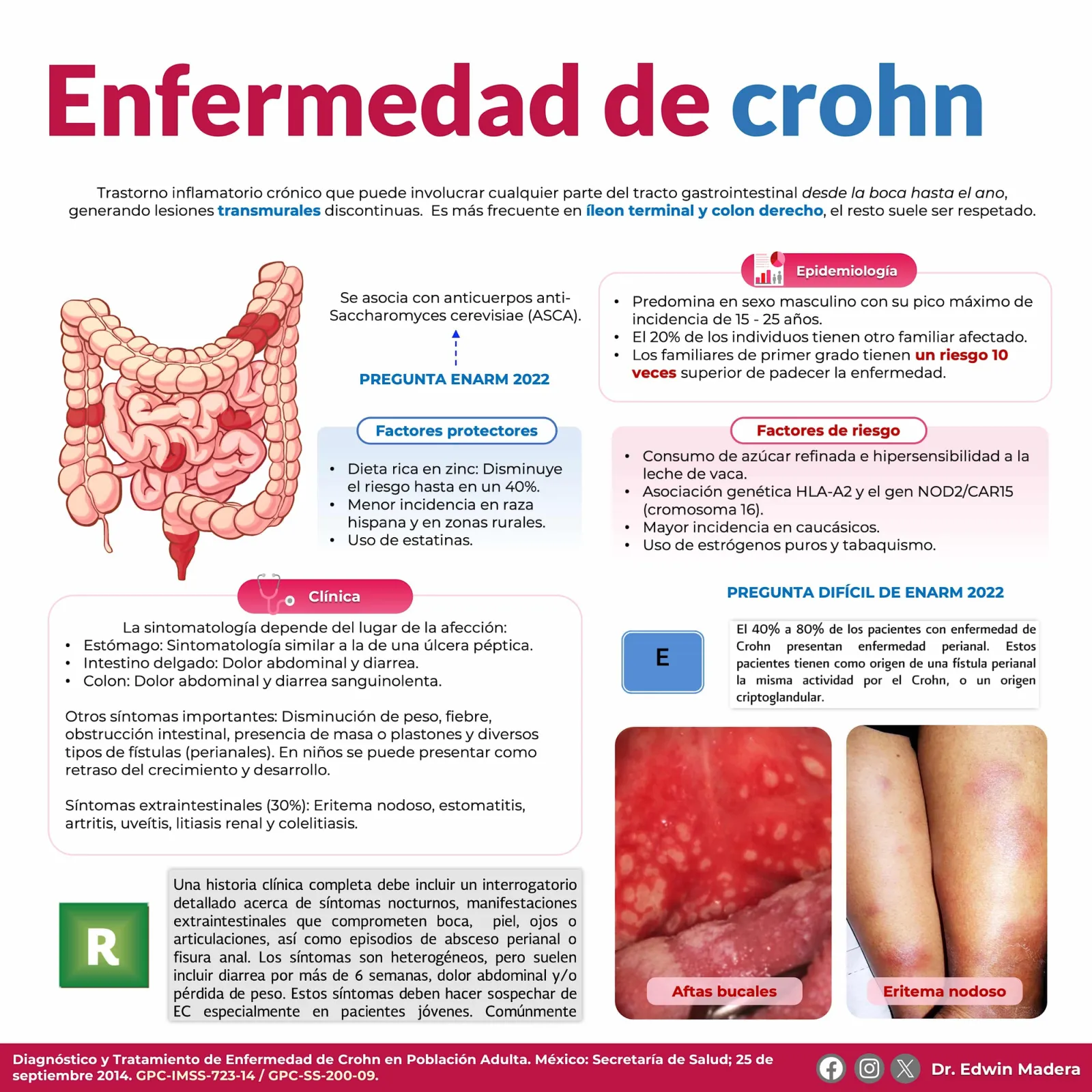 Enfermedad de Crohn