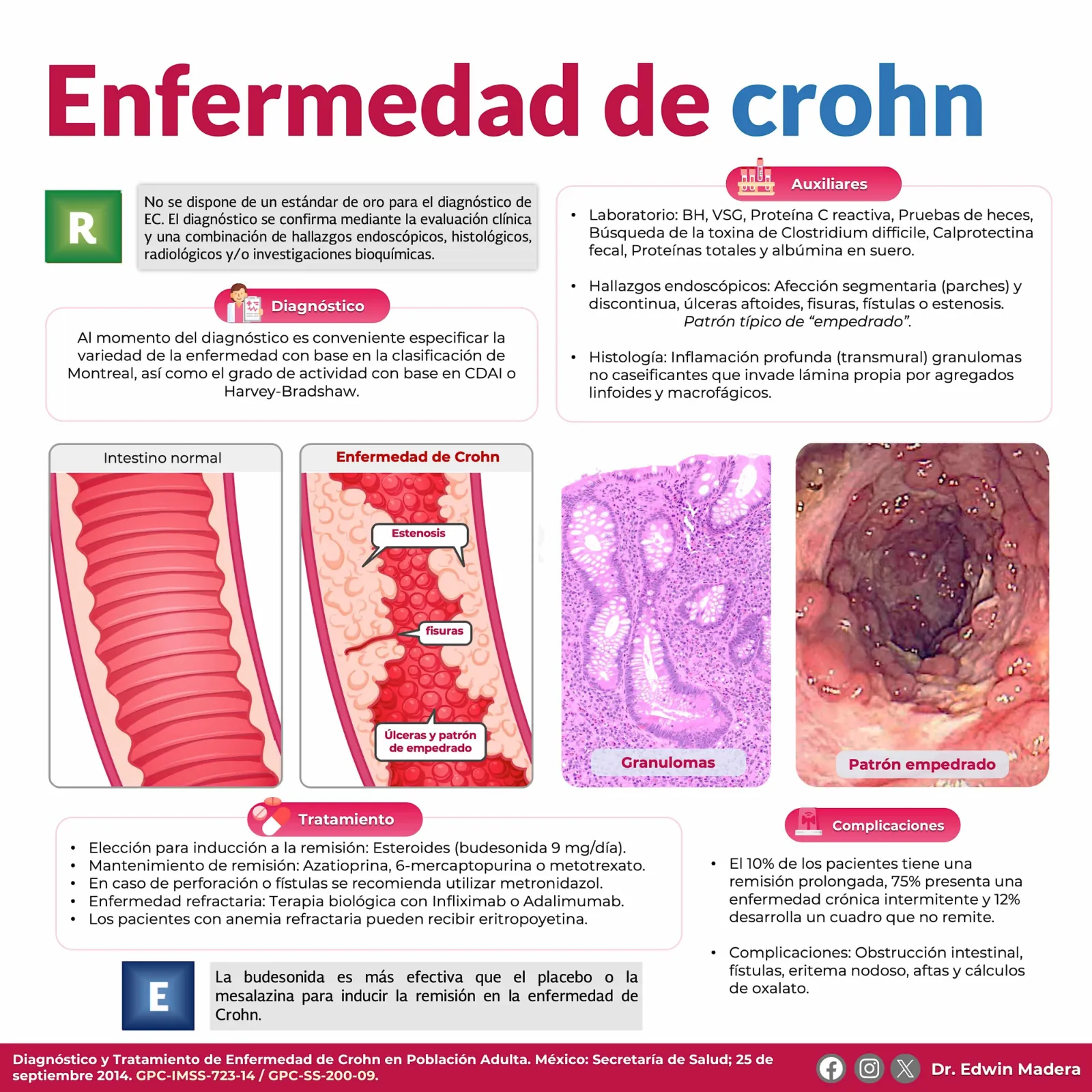 Enfermedad de Crohn