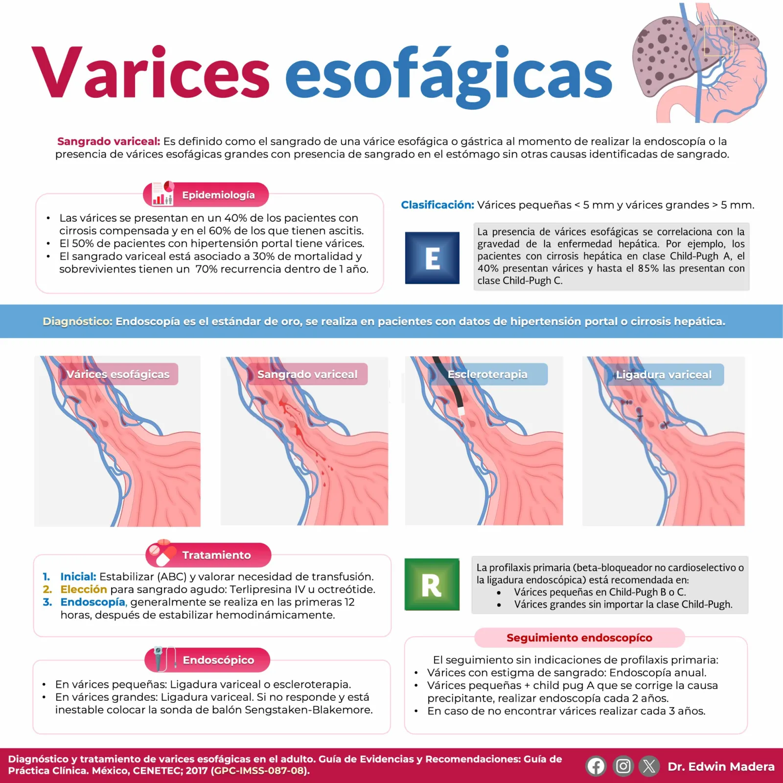 Varices esofágicas