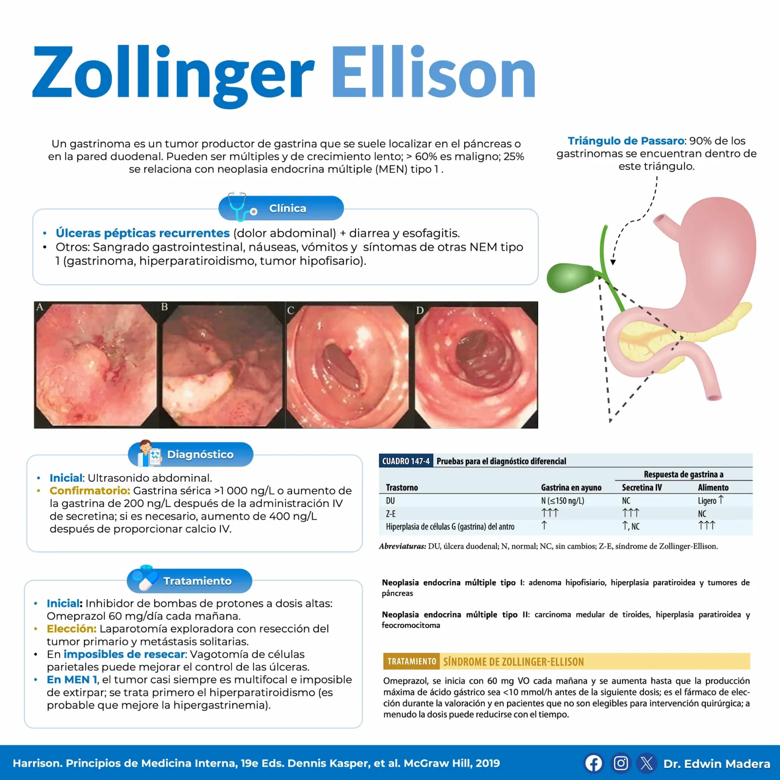 Zollinger Ellison