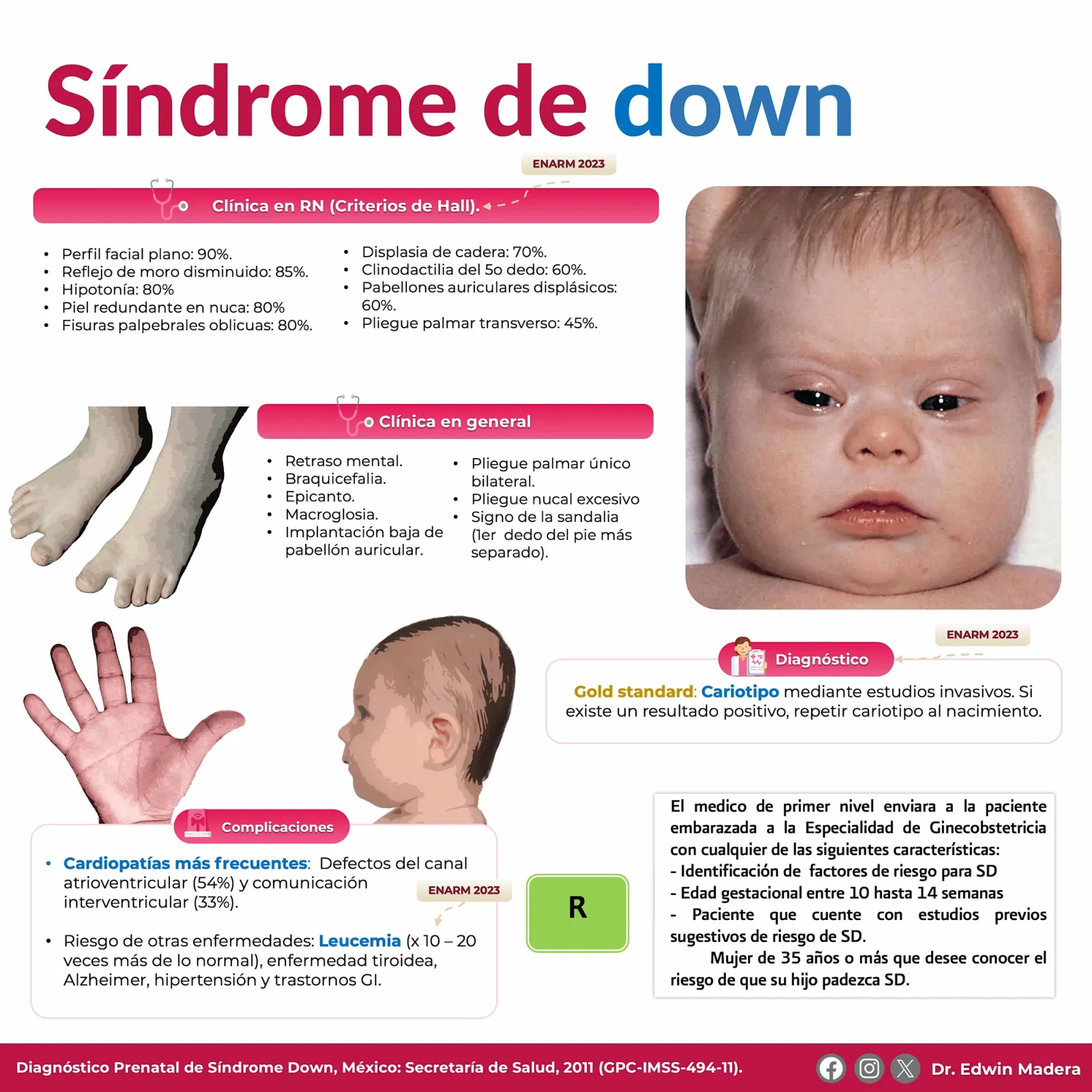 Síndrome de Down