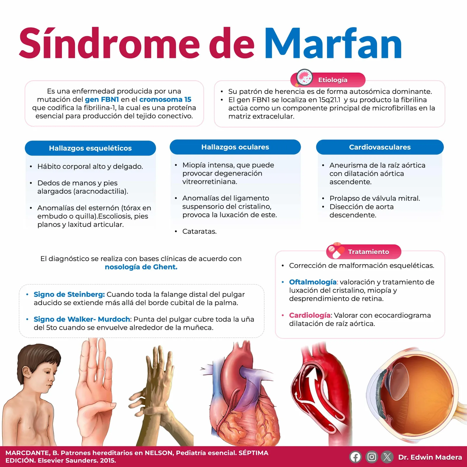 Síndrome de Marfan