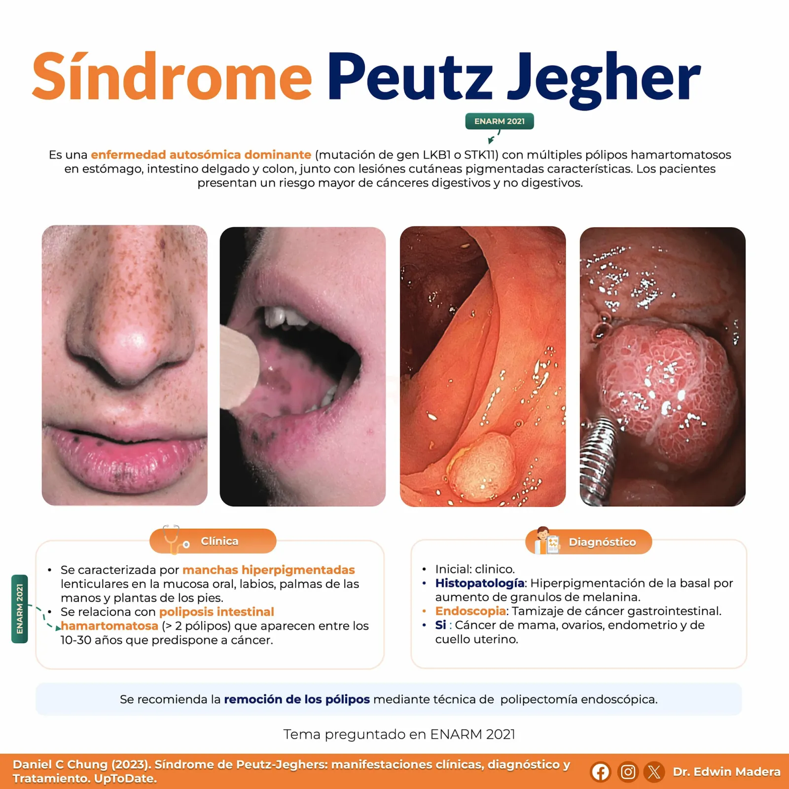 Síndrome de Peutz Jegher
